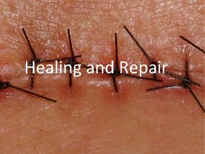 Healing and Repair Tissue repair restoration of tissue