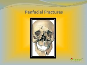 Panfacial Fractures Panfacial Fractures Panfacial fractures can be