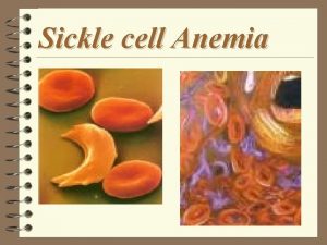 Sickle cell Anemia Background Information 4 Sickle cell