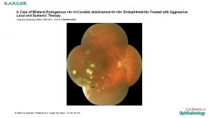 A Case of Bilateral Endogenous biCandida dubliniensisib Endophthalmitis
