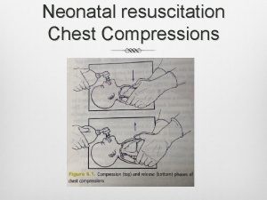 Neonatal resuscitation Chest Compressions Chest Compressions in Newborn