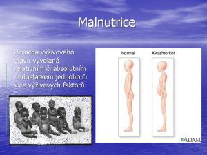 Malnutrice Porucha vivovho stavu vyvolan relativnm i absolutnm