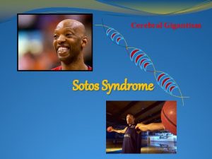 Cerebral Gigantism Sotos Syndrome What is It Sotos