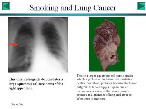 Smoking and Lung Cancer This chest radiograph demonstrates