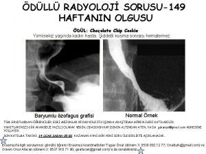 DLL RADYOLOJ SORUSU149 HAFTANIN OLGUSU DL Chocolate Chip