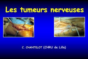 Les tumeurs nerveuses C CHANTELOT CHRU de Lille