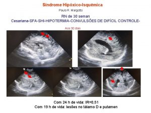 Sndrome HipxicoIsqumica Paulo R Margotto RN de 30