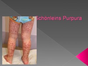 Henoch Schnleins Purpura General information Allergic vasculitis Children