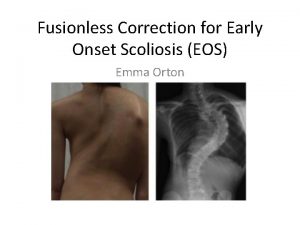 Fusionless Correction for Early Onset Scoliosis EOS Emma