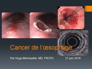 Cancer de lsophage Par Hugo Morrissette MD FRCPC