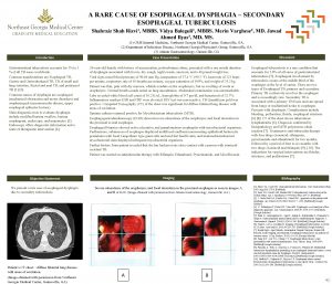 A RARE CAUSE OF ESOPHAGEAL DYSPHAGIA SECONDARY ESOPHAGEAL