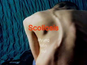 Scoliosis Myung Min Sul Types of Scoliosis Non
