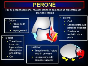 PERON Por su pequeo tamao muchas lesiones peroneas