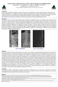 Fracture intra vertbrale de type Cleft chez le