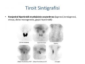 Tiroit Sintigrafisi Konjenital hipotiroidi etyolojisinin aratrlmas agenezi hemiagenezi