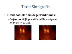 Tiroit Sintigrafisi Tiroid nodllerinin deerlendirilmesi Souk nodl hipoaktif