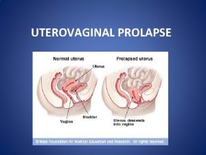 UTEROVAGINAL PROLAPSE A prolapse is a protrusion of