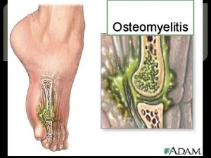 Osteomyelitis Def osteomyelitis is a severe pyogenic infection