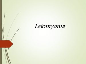 Leiomyoma Classification of Uterine Leiomyomas Diagnosis Leiomyomas are