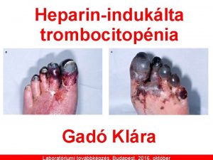 Heparininduklta trombocitopnia Gad Klra Laboratriumi tovbbkpzs Budapest 2016