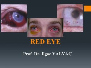 RED EYE Prof Dr Ilgaz YALVA RED EYE