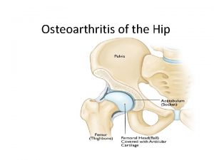 Osteoarthritis of the Hip Osteoarthritis of the Hip