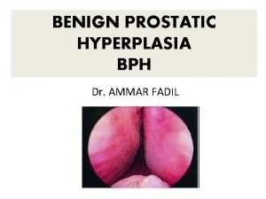 BENIGN PROSTATIC HYPERPLASIA BPH Dr AMMAR FADIL BPH