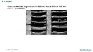 Treatment of Macular Degeneration with Sildenafil Results of