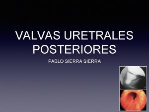 VALVAS URETRALES POSTERIORES PABLO SIERRA EPIDEMIOLOGIA 1 1250