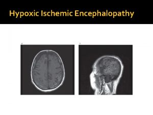 Hypoxic Ischemic Encephalopathy Electrolyte and Acidbase Disturbances Sodium