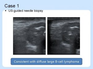 Case 1 USguided needle biopsy Consistent with diffuse