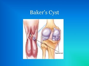 Bakers Cyst Development of Bakers Cysts The underlying