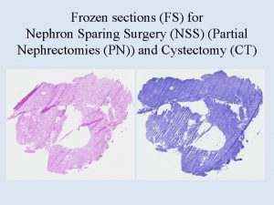 Frozen sections FS for Nephron Sparing Surgery NSS