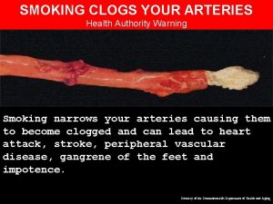 SMOKING CLOGS YOUR ARTERIES Health Authority Warning Smoking