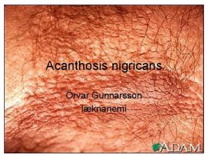 Acanthosis nigricans rvar Gunnarsson lknanemi Skilgreining Acanthosis Hyperplasia