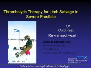 Thrombolytic Therapy for Limb Salvage in Severe Frostbite