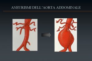 ANEURISMI DELLAORTA ADDOMINALE Aneurismi dellaorta addominale Definizione Epidemiologia