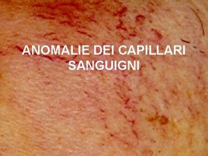 ANOMALIE DEI CAPILLARI SANGUIGNI Rosacea La rosacea una