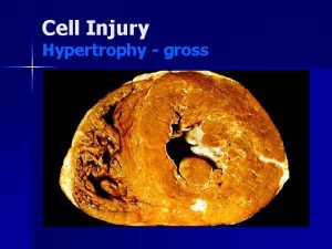 Cell Injury Hypertrophy gross Cell Injury Hypertrophy micro