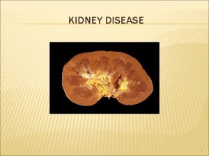 KIDNEY DISEASE 1 Nephritic syndrome acute onset characterized