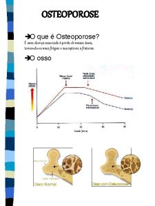 OSTEOPOROSE O que Osteoporose uma doena associada perda