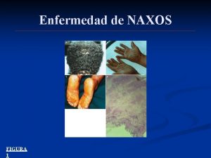 Enfermedad de NAXOS FIGURA 1 MUTACIONES GENETICAS ASOCIADAS