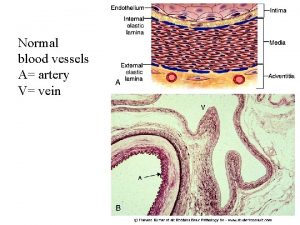 Normal blood vessels A artery V vein ARTERIOSCLEROSIS