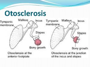 Otosclerosis Otosclerosis Otosclerosis is an autosomal dominant disease