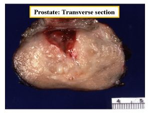 Prostate Transverse section Radical Prostatectomy Apex Bladder neck