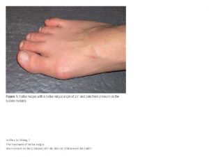 Wlker N Mittag F The Treatment of Hallux