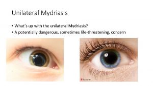 Unilateral Mydriasis Whats up with the unilateral Mydriasis