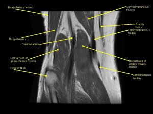 Biceps femoris tendon Semimembranosus muscle Gracilis tendon Semimembranosus