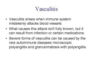 Vasculitis Vasculitis arises when immune system mistakenly attacks