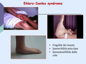 EhlersDanlos syndrome Fragilit dei tessuti Ipermobilit articolare Iperestensibilit